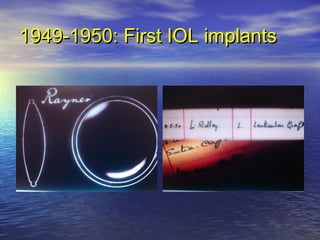 Cataract surgery for undergraduate | PPT