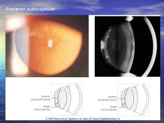 Cataract surgery for undergraduate | PPT