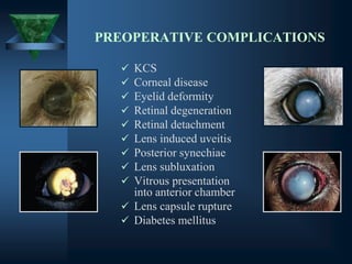 PREOPERATIVE COMPLICATIONS
✓ KCS
✓ Corneal disease
✓ Eyelid deformity
✓ Retinal degeneration
✓ Retinal detachment
✓ Lens induced uveitis
✓ Posterior synechiae
✓ Lens subluxation
✓ Vitrous presentation
into anterior chamber
✓ Lens capsule rupture
✓ Diabetes mellitus
 