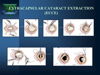 EXTRACAPSULAR CATARACT EXTRACTION
(ECCE)
 
