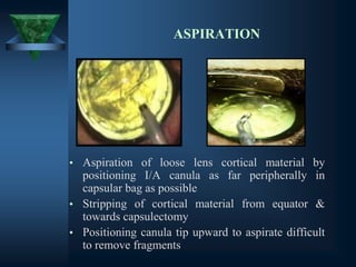 ASPIRATION
• Aspiration of loose lens cortical material by
positioning I/A canula as far peripherally in
capsular bag as possible
• Stripping of cortical material from equator &
towards capsulectomy
• Positioning canula tip upward to aspirate difficult
to remove fragments
 