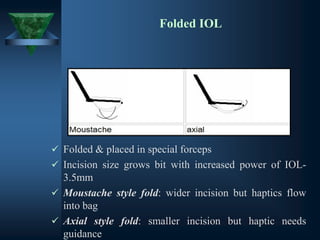 Folded IOL
✓ Folded & placed in special forceps
✓ Incision size grows bit with increased power of IOL-
3.5mm
✓ Moustache style fold: wider incision but haptics flow
into bag
✓ Axial style fold: smaller incision but haptic needs
guidance
 