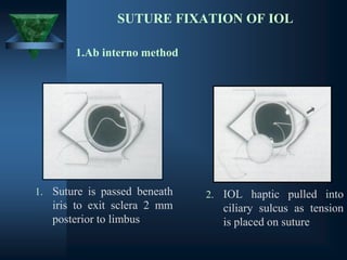 SUTURE FIXATION OF IOL
1. Suture is passed beneath
iris to exit sclera 2 mm
posterior to limbus
2. IOL haptic pulled into
ciliary sulcus as tension
is placed on suture
1.Ab interno method
 