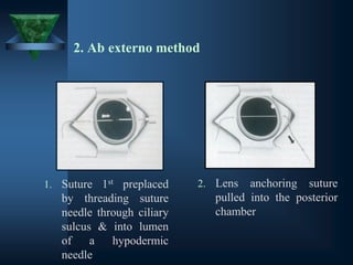 2. Ab externo method
1. Suture 1st preplaced
by threading suture
needle through ciliary
sulcus & into lumen
of a hypodermic
needle
2. Lens anchoring suture
pulled into the posterior
chamber
 
