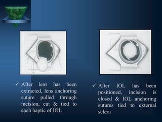 ✓ After lens has been
extracted, lens anchoring
suture pulled through
incision, cut & tied to
each haptic of IOL
✓ After IOL has been
positioned, incision is
closed & IOL anchoring
sutures tied to external
sclera
 