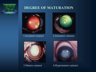 DEGREE OF MATURATION
1.Incipient cataract 2.Immature cataract.
3.Mature cataract 4.Hypermature cataract
 
