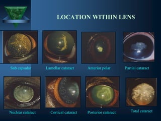 LOCATION WITHIN LENS
Sub capsular Lamellar cataract Anterior polar Partial cataract
Nuclear cataract Cortical cataract Total cataractPosterior cataract
 