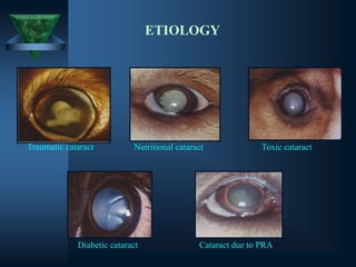 ETIOLOGY
Traumatic cataract Nutritional cataract Toxic cataract
Diabetic cataract Cataract due to PRA
 