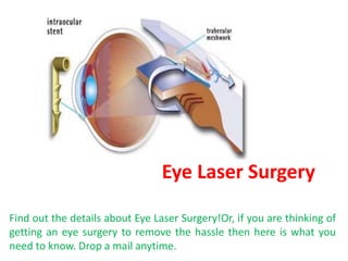 Eye Laser Surgery
Find out the details about Eye Laser Surgery!Or, if you are thinking of
getting an eye surgery to remove the hassle then here is what you
need to know. Drop a mail anytime.
 