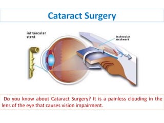 Do you know about Cataract Surgery? It is a painless clouding in the
lens of the eye that causes vision impairment.