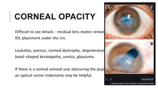 CORNEAL OPACITY
Difficult to see details : residual lens matter remained/
IOL placement under the iris.
Leukoma, pannus, corneal dystrophy, degeneration, and
band-shaped keratopathy, uveitis, glaucoma.
If there is a central corneal scar obscuring the pupil,
an optical sector iridectomy may be helpful.
 