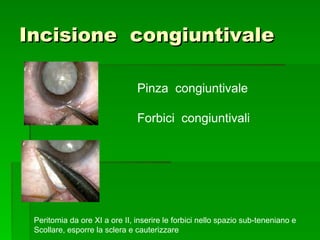 Incisione congiuntivaleIncisione congiuntivale
Pinza congiuntivale
Forbici congiuntivali
Peritomia da ore XI a ore II, inserire le forbici nello spazio sub-teneniano e
Scollare, esporre la sclera e cauterizzare
 