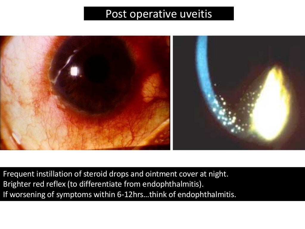 Cataract Surgery Complications for General Practitioners