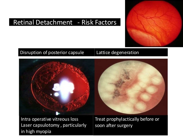 Cataract Surgery Complications for General Practitioners