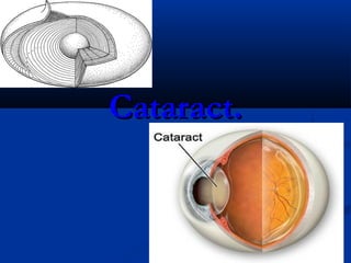 Cataract.Cataract.
 