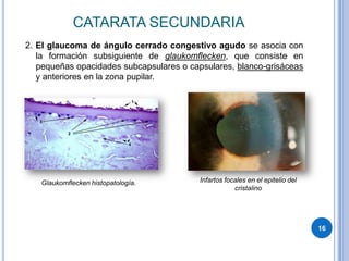 CATARATA SECUNDARIA
2. El glaucoma de ángulo cerrado congestivo agudo se asocia con
   la formación subsiguiente de glauko...