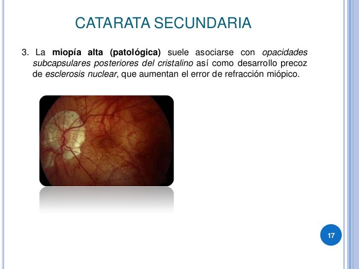 Catarata