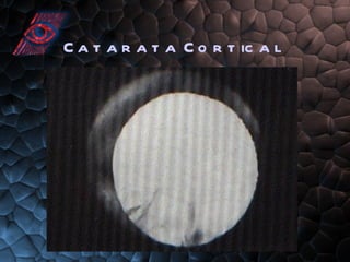 Catarata Cortical 