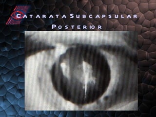 Catarata Subcapsular Posterior 