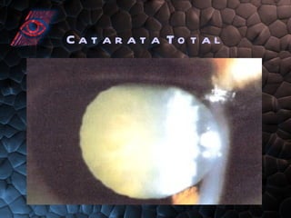 Catarata Total 