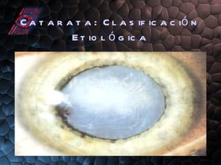 Catarata:  Clasificación Etiológica 
