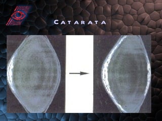 Catarata 