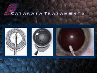 Catarata Tratamiento 