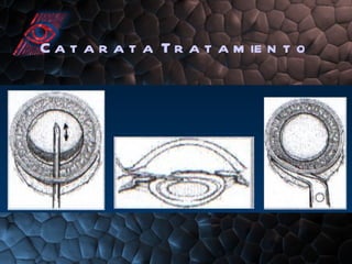 Catarata Tratamiento 