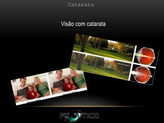 Visão com catarata
 