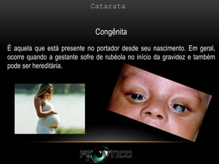 Congênita
É aquela que está presente no portador desde seu nascimento. Em geral,
ocorre quando a gestante sofre de rubéola no início da gravidez e também
pode ser hereditária.
 