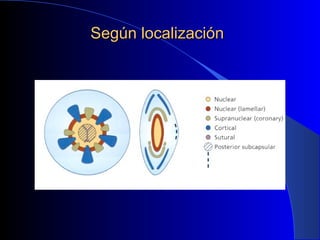 Según localizaciónSegún localización
 