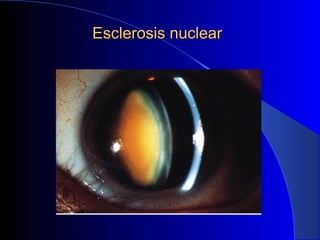 Esclerosis nuclearEsclerosis nuclear
 