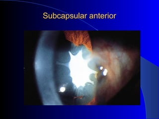 Subcapsular anteriorSubcapsular anterior
 