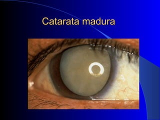 Catarata maduraCatarata madura
 