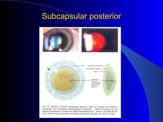 Subcapsular posteriorSubcapsular posterior
 
