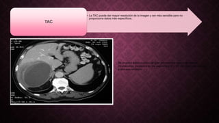 • La TAC puede dar mayor resolución de la imagen y ser más sensible pero no
proporciona datos más específicos.
TAC
Se muestra lesion quistica de gran tamanio con signos de ruptura
intrahepatica, localizada en los segmentos VI y VII del higado secundario
a absceso amibiano
 