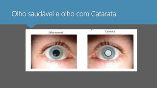 Olho saudável e olho com Catarata
 