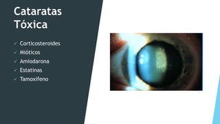 Cataratas
Tóxica
 Corticosteroides
 Mióticos
 Amiodarona
 Estatinas
 Tamoxifeno
 