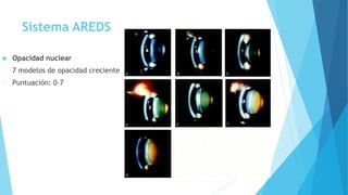 Sistema AREDS
 Opacidad nuclear
- 7 modelos de opacidad creciente
- Puntuación: 0-7
 