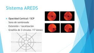 Sistema AREDS
 Opacidad Cortical / SCP
- Sona de sombreado
- Extensión / localización
- Gradilla de 3 círculos /17 áreas)
 
