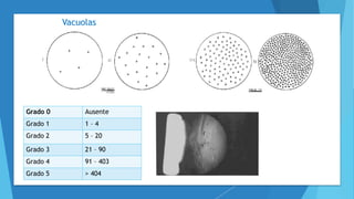 Vacuolas
Grado 0 Ausente
Grado 1 1 – 4
Grado 2 5 – 20
Grado 3 21 – 90
Grado 4 91 – 403
Grado 5 > 404
 