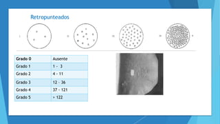 Retropunteados
Grado 0 Ausente
Grado 1 1 - 3
Grado 2 4 - 11
Grado 3 12 – 36
Grado 4 37 - 121
Grado 5 > 122
 