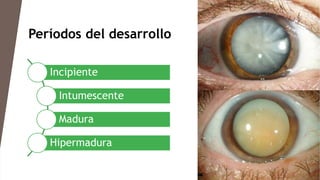 Períodos del desarrollo
Incipiente
Intumescente
Madura
Hipermadura
 