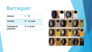Barraquer
Núclear 1 – 10
Cortical 0 – 3 cruses
Subcapsular
posterior
0– 3 cruses
 