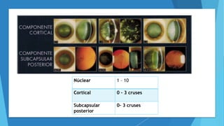 Núclear 1 – 10
Cortical 0 – 3 cruses
Subcapsular
posterior
0– 3 cruses
 