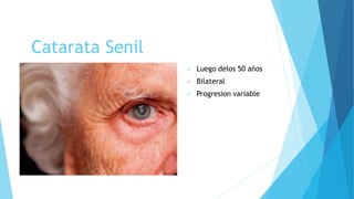 Catarata Senil
 Luego delos 50 años
 Bilateral
 Progresion variable
 