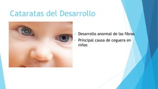 Cataratas del Desarrollo
 Desarrollo anormal de las fibras
 Principal causa de ceguera en
niños
 