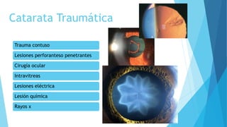 Catarata Traumática
Trauma contuso
Lesiones perforanteso penetrantes
Cirugía ocular
Intravitreas
Lesiones eléctrica
Lesión química
Rayos x
 