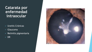 Catarata por
enfermedad
intraocular
 Uveitis Crónicas
 Glaucoma
 Retinitis pigmentaria
 DR
 