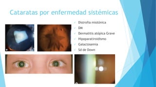 Cataratas por enfermedad sistémicas
 Distrofia miotónica
 DM
 Dermatitis atópica Grave
 Hipoparatiroidismo
 Galactosemia
 Sd de Down
 